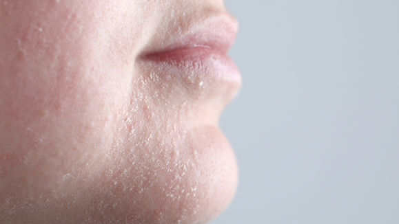 4 Steps Solution to Combat Dryness | Bentica bentica.