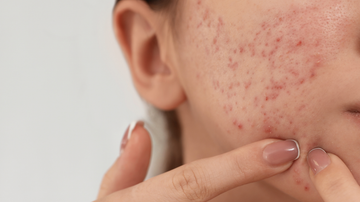 Ways to Get Rid of Acne Naturally I Bentica.