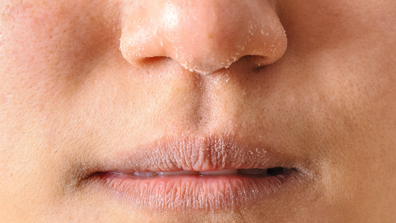 How to manage dry and flaky skin during winter? bentica.