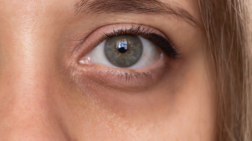 How to get rid of dark circles under the eyes? bentica.