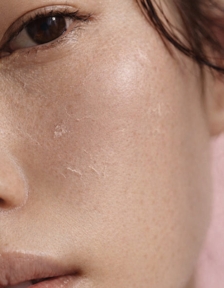 Dry and Dehydrated Skin